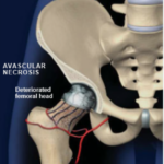 Plasme Ric en Plaquetes, Necrosis avascular cap femur