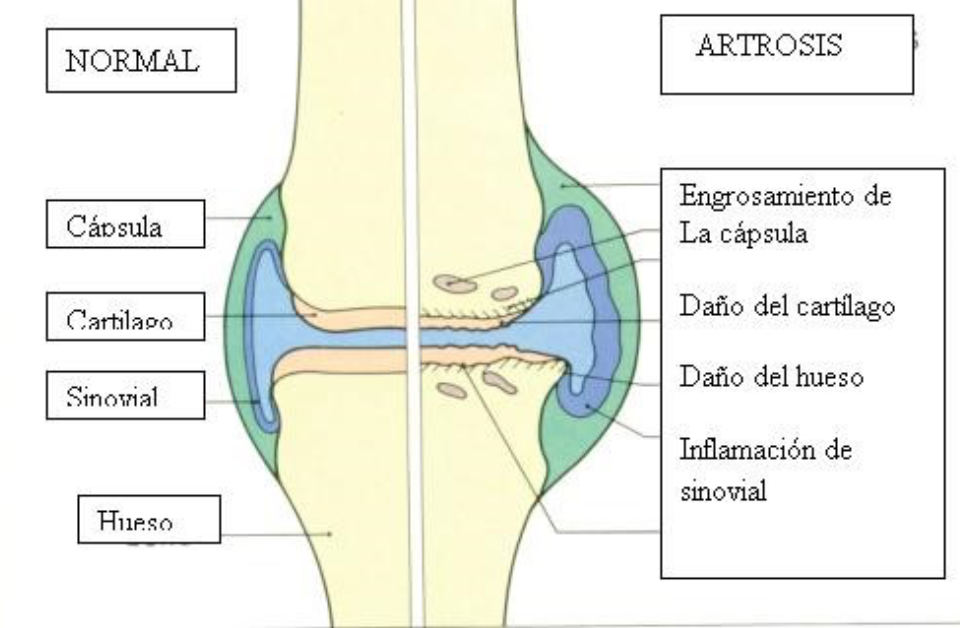 Degenración cartílago articular de rodilla.